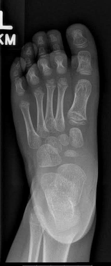 Normal Foot Of Child Buyxraysonline