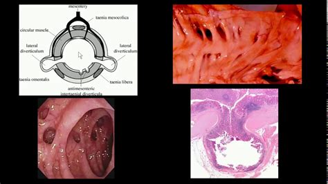 óstios Diverticulares No Cólon