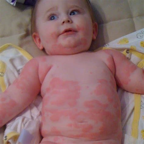 Urticaria En Bebés Y Recién Nacidos 12 Fotos Síntomas Y Tratamiento