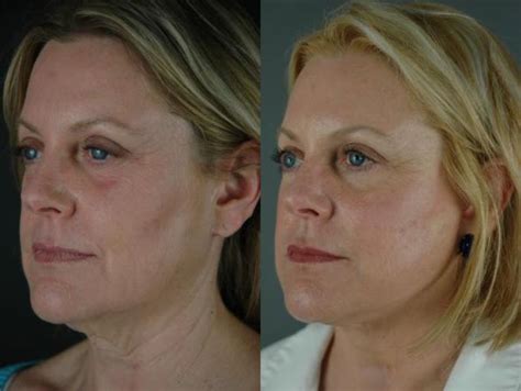 Macs Lift And Lower Blepharoplasty Patient 1