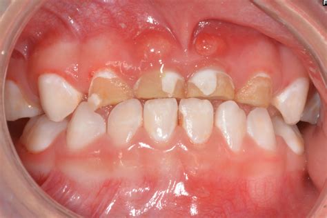 Early Childhood Caries Symptoms White Spot Lesions Tooth Decay Pain