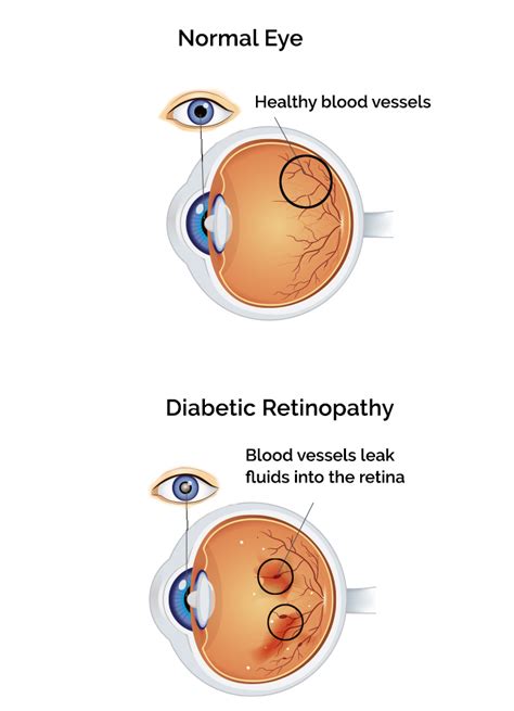 Diabetic Retinopathy Diabetes Eye Exam In Grabill