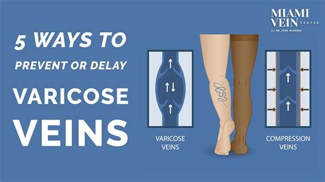 5 Ways To Prevent Varicose Veins Or Keep Existing Varicose Veins From