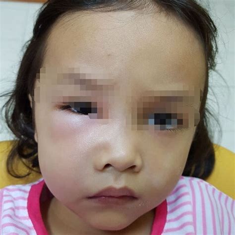 Maybe you would like to learn more about one of these? Gara-Gara Jarang Berus Gigi, Muka Anak Bengkak Tahan Sakit ...