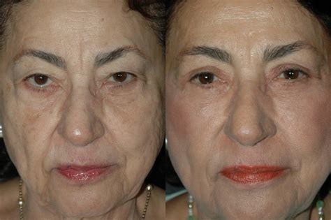 Transcutaneous Blepharoplasty With Volume Preservation Plastic