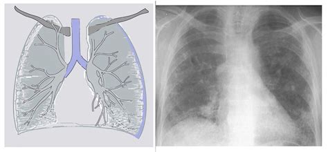 Pericarditis is classically associated with ecg changes that evolve through four stages. La radiographie thoracique du sujet âgé au cours des ...