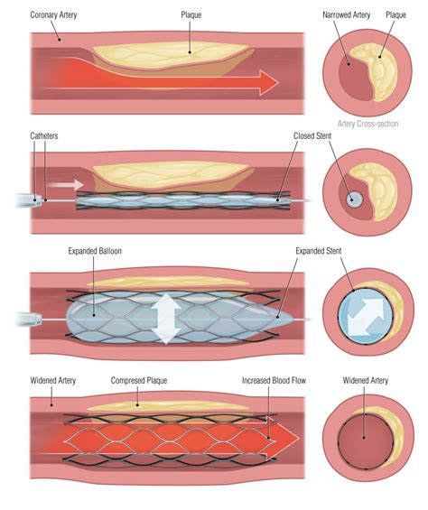 Coronary Angioplasty Stent Insertion Procedure Risks And Benefits