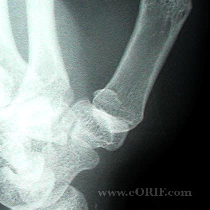 Bennett's Fracture S62.213A 815.01 | eORIF