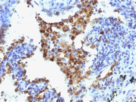 Napsin A Lung Adenocarcinoma Marker Monoclonal Antibody Napsa1238