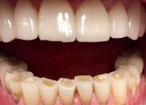 Bonding For Worn Down Teeth Dr Gentry
