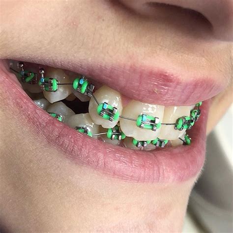 Best Braces Colors For Boys To Wear To Appeal To Girls Braces Explained