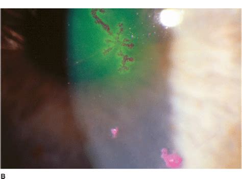 Symptoms and signs include foreign body sensation. Corneal Infections, Inflammations, and Surface Disorders ...