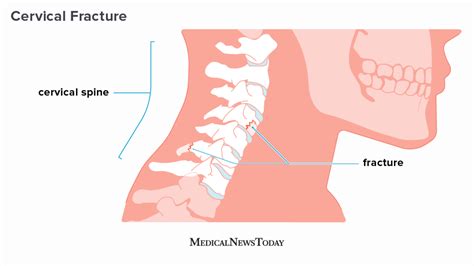 Cervical Neck Fracture