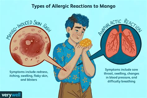 Mango Allergy Symptoms Causes Diagnosis Treatment