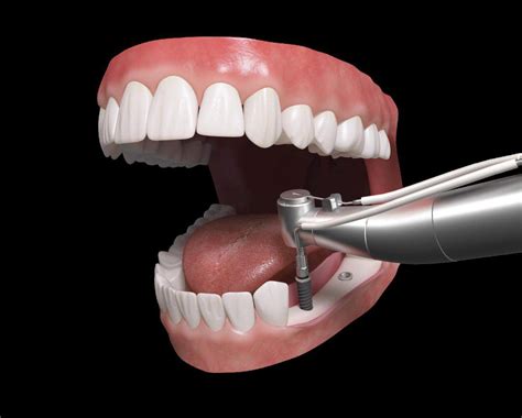 Todo Lo Que Debes Saber Sobre Los Implantes Dentales Calidad Territorial