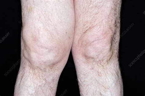 Swollen Knee In Osteoarthritis Stock Image C0110408 Science Photo Library