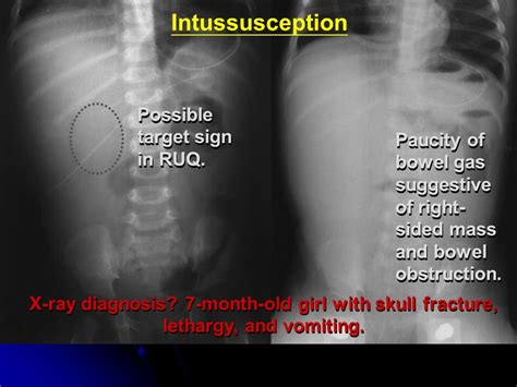 Target Sign Intussusception Abdominal X Ray Plain Abdominal Xray Of