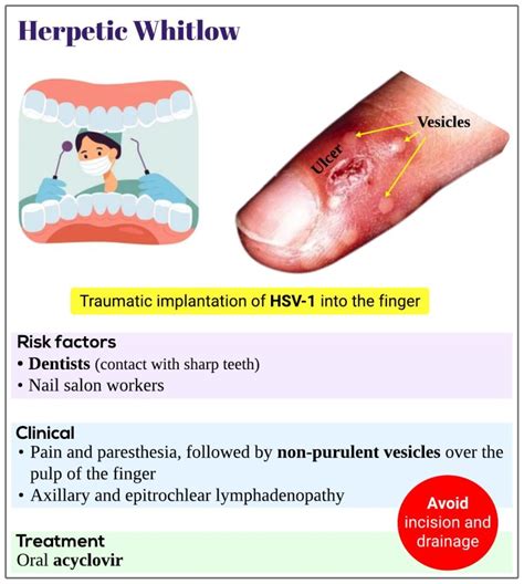 Herpetic Whitlow Medicine Keys For Mrcps