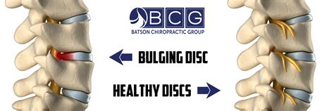 herniated discs pinched nerves and bulging discs batson chirohealth group