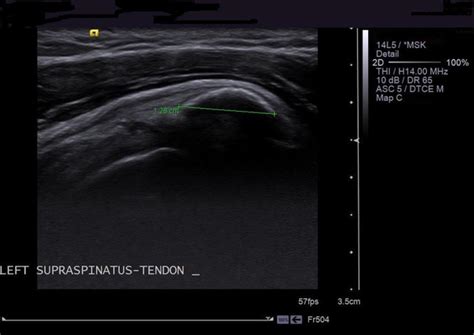 Plain Radiographic Evidence Of Stages Of Calcifying Tendinitis Of Supraspinatus Tendon Of