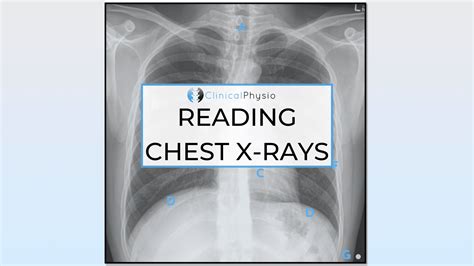 Reading Chest X Rays Clinical Physio Membership