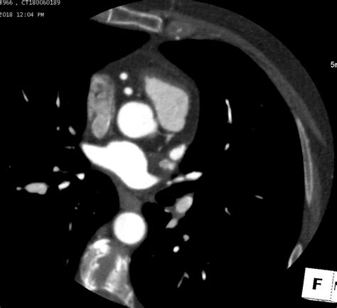 Axial Image Showing Thin Atretic Left Main Artery Download