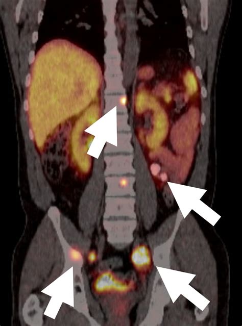 X Rays Ct Scans Mri And Other Tests For Adrenal Glands