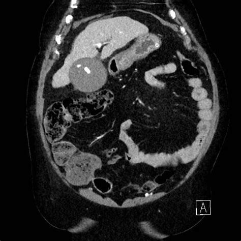 Abdominal Ct With Contrast Axial Plane Distended Gallbladder With