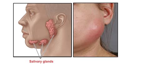Can Sinus Infection Cause Swollen Salivary Glands