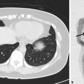 PET CT Scan Revealed A Solitary Pulmonary Nodule In The Right Lower Download Scientific Diagram