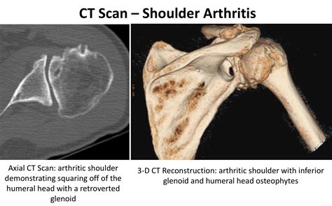 Arthritis Cambridge Shoulder