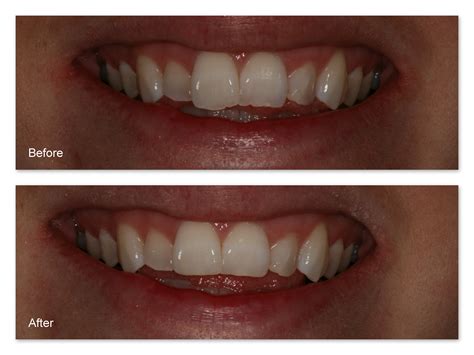 Enamel Reshaping Gallery Dr Jack M Hosner Dds