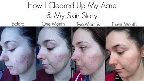 How I Cleared Up My Acne And My Skin Story Youtube