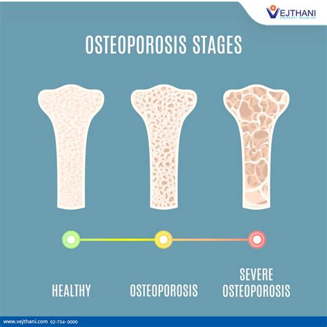 What Is Osteoporosis And How Is It Diagnosed