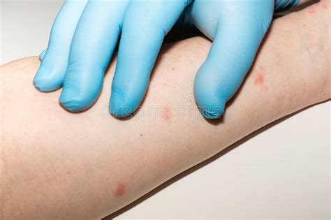Allergic Skin Rash On The Inner Surface Of The Forearm Medical
