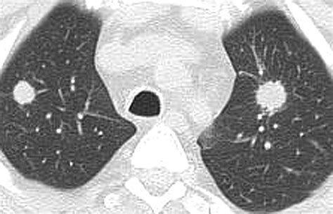 Wegeners Granulomatosis In The Chest High Resolution Ct Findings Ajr