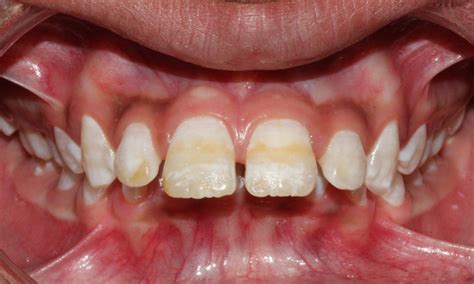 What Is Fluorosis And How To Treat It Amazing Smiles