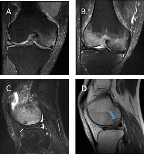 A 44 Year Old Man With Knee Pain Without Injury Jbjs Image Quiz