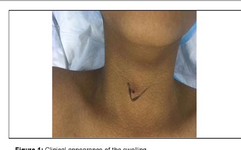Figure 1 From Pilomatrixoma A Rare Cause Of Midline Neck Swelling