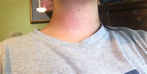 Does Anyone Experience Neck Rashes Ive Had Rashes In Other Places But