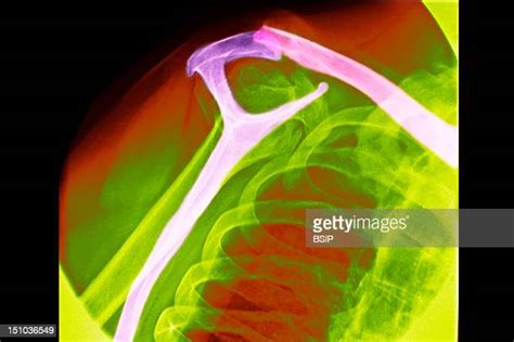 Clavicle Fracture Photos And Premium High Res Pictures Getty Images