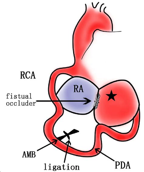 A Schematic Diagram Of The Operation Rca Significantly Tortuous And