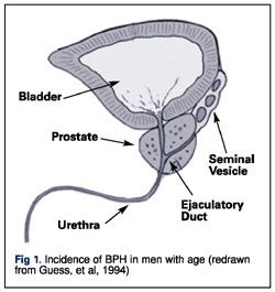 It is also known as a prostate adenoma (or benign prostatic hyperplasia. Prostate Health - helps fight DHT binding