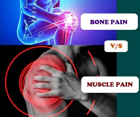 Bone Pain Vs Muscle Pain In Ckd All Things Kidney ~ Official