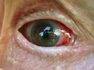 Mature Cataract Eyerounds Ophthalmic Atlas