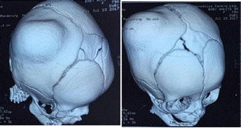 Ct Scan Of Head With 3d Reconstruction Preoperative Download