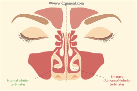 What You Need To Know About Inferior Turbinate Hyperthrophy Swollen