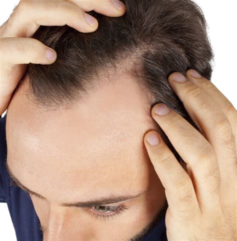 Mens Hair Loss What You Need To Know