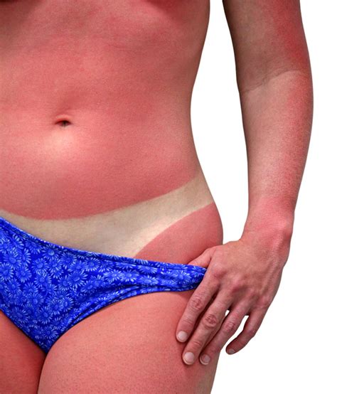 Severe Sunburn Is On The Rise Health Authorities Are Worried — Campaspe Fp