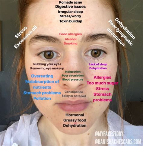 Can Face Mapping Really Help Improve Your Skin Acne Face Mapping